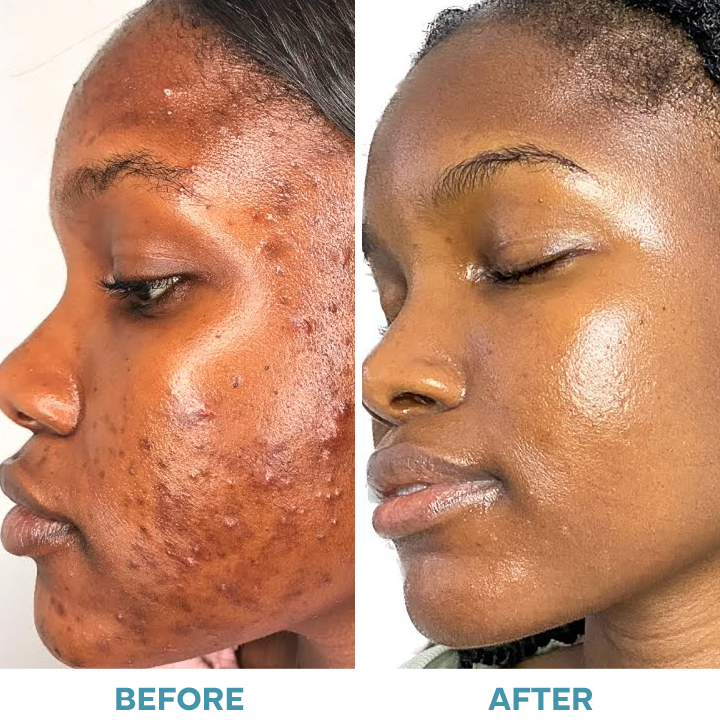 LIMETOW™ Pimple Cover Liquid Patch