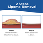 MEDix™ Lipoma Removal Cream