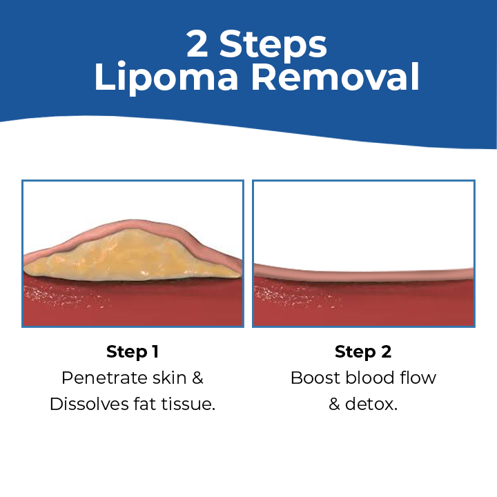 MEDix™ Lipoma Removal Cream