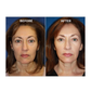 ShapeZ™ EMS Red Light Face Treatment