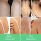LIMETOW™ Back Acne Treatment Spray