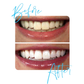 Lanthome™ Teeth Whitening Mousse